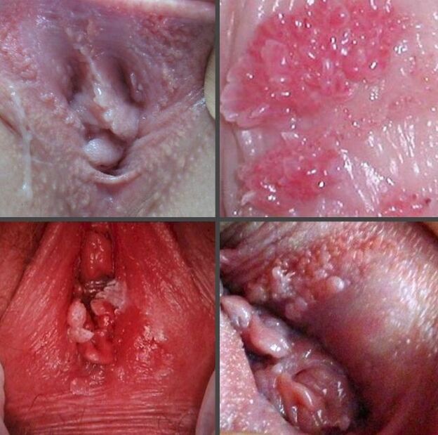 Apropiere de papiloame în vagin