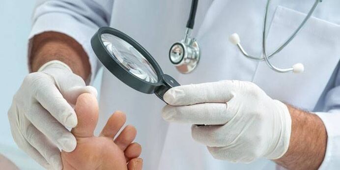 medicul examinează piciorul cu un neg pe picior