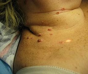 papilomavirus uman pe gât