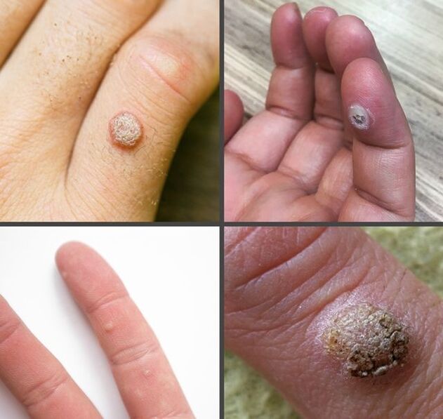 Tipuri comune de veruci pe degete